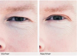 Augenlid-Liftingstripes Gr. M -Pflegeprodukte MAM 3810471 SHOP IMAGE 1.4